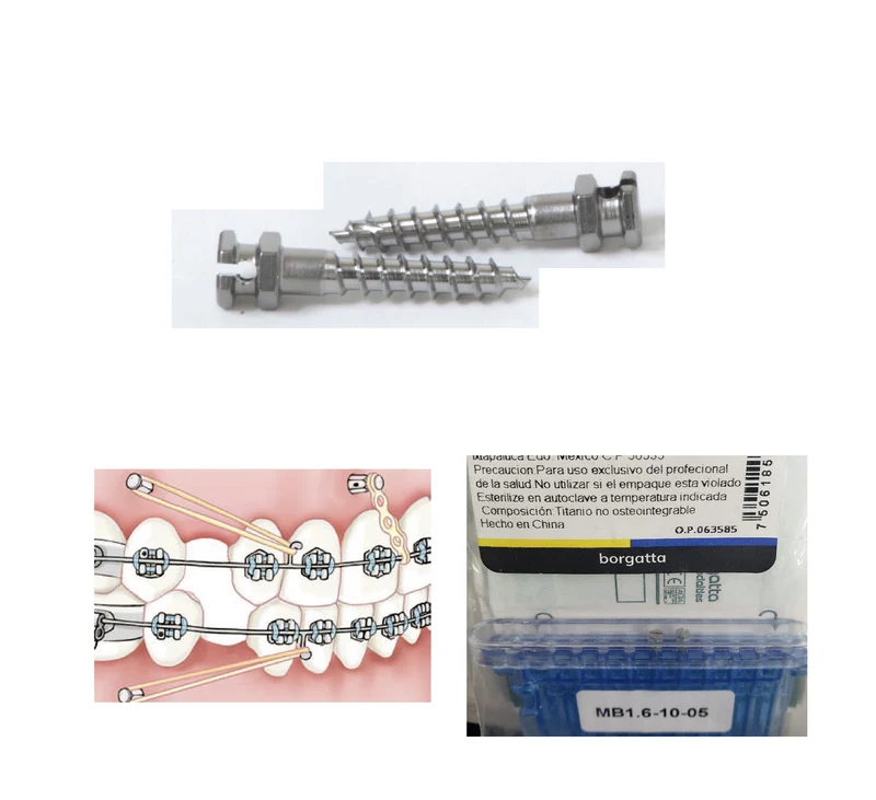 Micro Implantes mini Dentales Ortodoncia Borgatta Elite Ortho